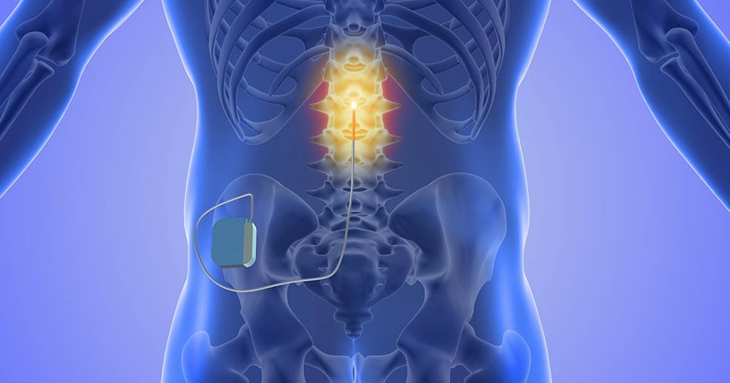 Neuromodulation Therapies for Persistent Pain