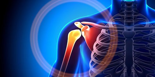 Shoulder arthritis